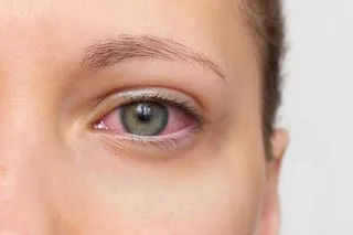 Allergic conjunctivitis