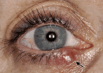 Stye (hordeolum)
