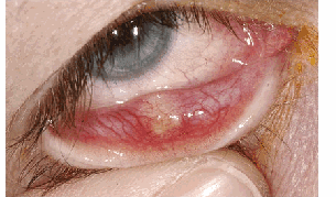 Chalazion