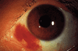 Subconjunctival haemorrhage