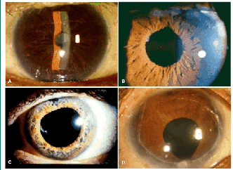 Anterior uveitis