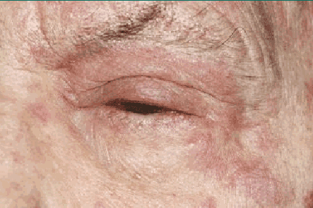 Shingles (herpes zoster)