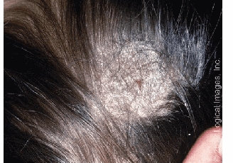 Ringworm (fungal)