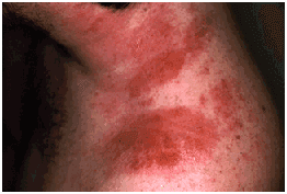 Contact dermatitis