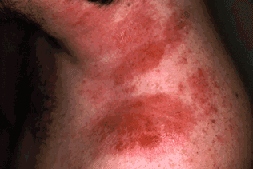 Contact dermatitis