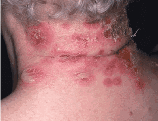 Bullous impetigo