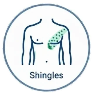 Shingles