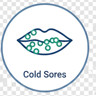 Cold Sores