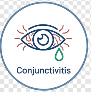 Conjunctivitis