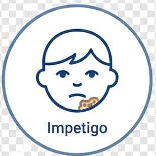 Impetigo